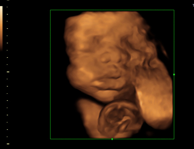 3D ultrasound image at 30 weeks